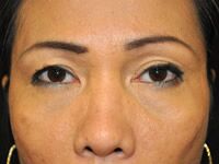 Eyelid shop surgery hawaii