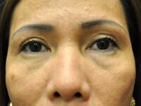 Eyelid surgery clearance hawaii